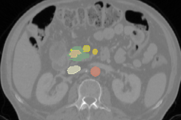 Revolutionizing Pancreatic Cancer Surgery: How Deep Learning Could Change Resectability Assessments Forever