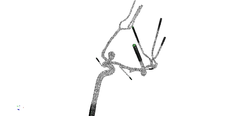 Revolutionizing Aneurysm Treatment: The Breakthrough in Contact-Resolved Deployment of the Contour Neurovascular System