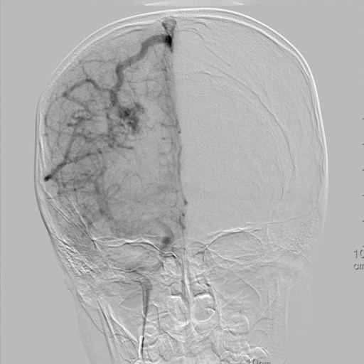 Revolutionizing Blood Vessel Imaging: The Breakthrough of UI-VISA in Vascular Image Segmentation